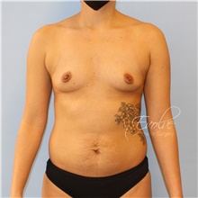 Breast Augmentation Before Photo by Jason Hess, MD; San Diego, CA - Case 48498