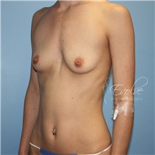 Breast Augmentation Before Photo by Jason Hess, MD; San Diego, CA - Case 48500