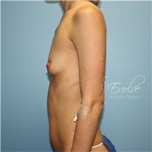 Breast Augmentation Before Photo by Jason Hess, MD; San Diego, CA - Case 48500