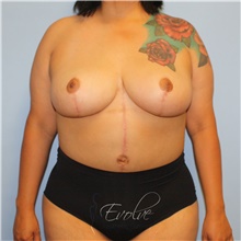 Breast Reduction After Photo by Jason Hess, MD; San Diego, CA - Case 48519