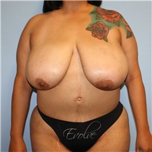 Breast Reduction Before Photo by Jason Hess, MD; San Diego, CA - Case 48519