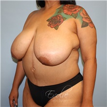 Breast Reduction Before Photo by Jason Hess, MD; San Diego, CA - Case 48519