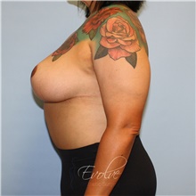 Breast Reduction After Photo by Jason Hess, MD; San Diego, CA - Case 48519