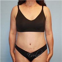 Tummy Tuck After Photo by Jason Hess, MD; San Diego, CA - Case 48556