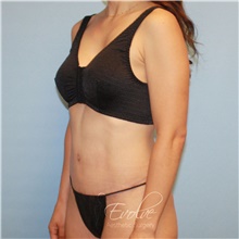 Tummy Tuck After Photo by Jason Hess, MD; San Diego, CA - Case 48588