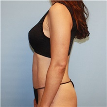 Tummy Tuck After Photo by Jason Hess, MD; San Diego, CA - Case 48588