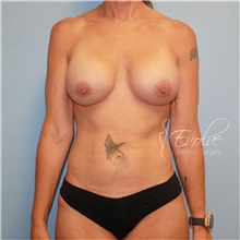 Breast Implant Revision After Photo by Jason Hess, MD; San Diego, CA - Case 48709