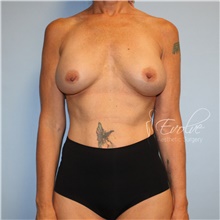 Breast Implant Revision Before Photo by Jason Hess, MD; San Diego, CA - Case 48709