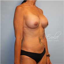 Breast Implant Revision After Photo by Jason Hess, MD; San Diego, CA - Case 48709