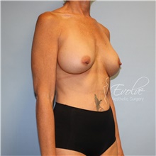 Breast Implant Revision Before Photo by Jason Hess, MD; San Diego, CA - Case 48709
