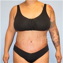 Tummy Tuck After Photo by Jason Hess, MD; San Diego, CA - Case 49066