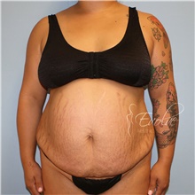 Tummy Tuck Before Photo by Jason Hess, MD; San Diego, CA - Case 49066