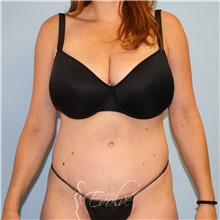 Tummy Tuck After Photo by Jason Hess, MD; San Diego, CA - Case 49173