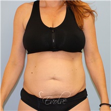 Tummy Tuck Before Photo by Jason Hess, MD; San Diego, CA - Case 49173