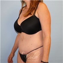 Tummy Tuck After Photo by Jason Hess, MD; San Diego, CA - Case 49173