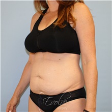 Tummy Tuck Before Photo by Jason Hess, MD; San Diego, CA - Case 49173