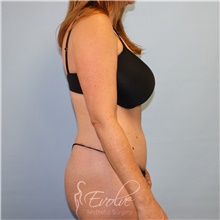 Tummy Tuck After Photo by Jason Hess, MD; San Diego, CA - Case 49173