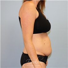 Tummy Tuck Before Photo by Jason Hess, MD; San Diego, CA - Case 49173