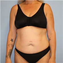 Tummy Tuck Before Photo by Jason Hess, MD; San Diego, CA - Case 49174