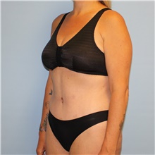 Tummy Tuck After Photo by Jason Hess, MD; San Diego, CA - Case 49174