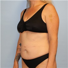 Tummy Tuck Before Photo by Jason Hess, MD; San Diego, CA - Case 49174