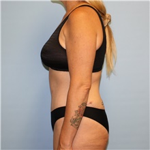 Tummy Tuck After Photo by Jason Hess, MD; San Diego, CA - Case 49174