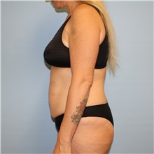 Tummy Tuck Before Photo by Jason Hess, MD; San Diego, CA - Case 49174