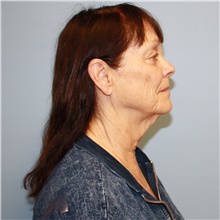 Facelift Before Photo by Jason Hess, MD; San Diego, CA - Case 49175