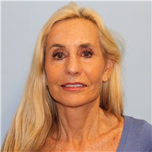 Facelift After Photo by Jason Hess, MD; San Diego, CA - Case 49176