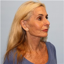 Facelift After Photo by Jason Hess, MD; San Diego, CA - Case 49176