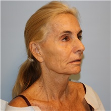 Facelift Before Photo by Jason Hess, MD; San Diego, CA - Case 49176