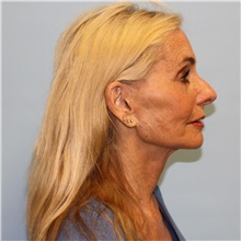 Facelift After Photo by Jason Hess, MD; San Diego, CA - Case 49176