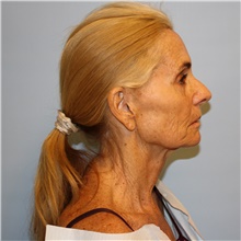 Facelift Before Photo by Jason Hess, MD; San Diego, CA - Case 49176