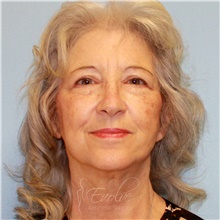 Facelift After Photo by Jason Hess, MD; San Diego, CA - Case 49192