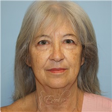 Facelift Before Photo by Jason Hess, MD; San Diego, CA - Case 49192