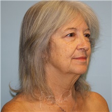 Facelift Before Photo by Jason Hess, MD; San Diego, CA - Case 49192