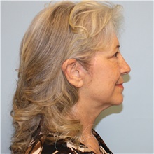 Facelift After Photo by Jason Hess, MD; San Diego, CA - Case 49192