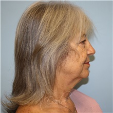 Facelift Before Photo by Jason Hess, MD; San Diego, CA - Case 49192