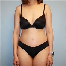 Tummy Tuck After Photo by Jason Hess, MD; ,  - Case 50259