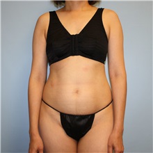 Tummy Tuck Before Photo by Jason Hess, MD; ,  - Case 50259