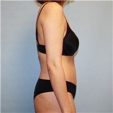 Tummy Tuck After Photo by Jason Hess, MD; ,  - Case 50259