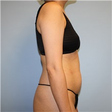 Tummy Tuck Before Photo by Jason Hess, MD; ,  - Case 50259