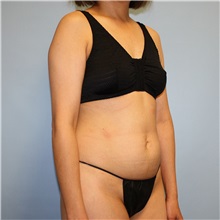Tummy Tuck Before Photo by Jason Hess, MD; ,  - Case 50259