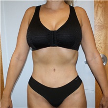 Tummy Tuck After Photo by Jason Hess, MD; ,  - Case 50256