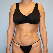 Tummy Tuck Before Photo by Jason Hess, MD; ,  - Case 50256