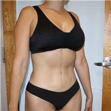 Tummy Tuck After Photo by Jason Hess, MD; ,  - Case 50256