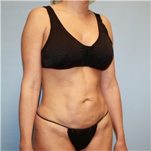 Tummy Tuck Before Photo by Jason Hess, MD; ,  - Case 50256