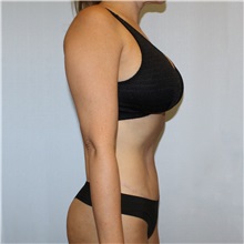 Tummy Tuck After Photo by Jason Hess, MD; ,  - Case 50256