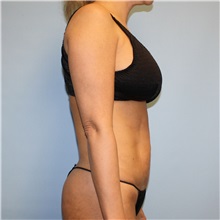 Tummy Tuck Before Photo by Jason Hess, MD; ,  - Case 50256