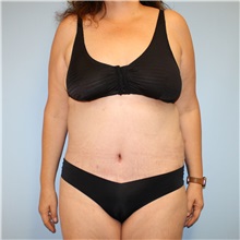 Tummy Tuck After Photo by Jason Hess, MD; ,  - Case 50257
